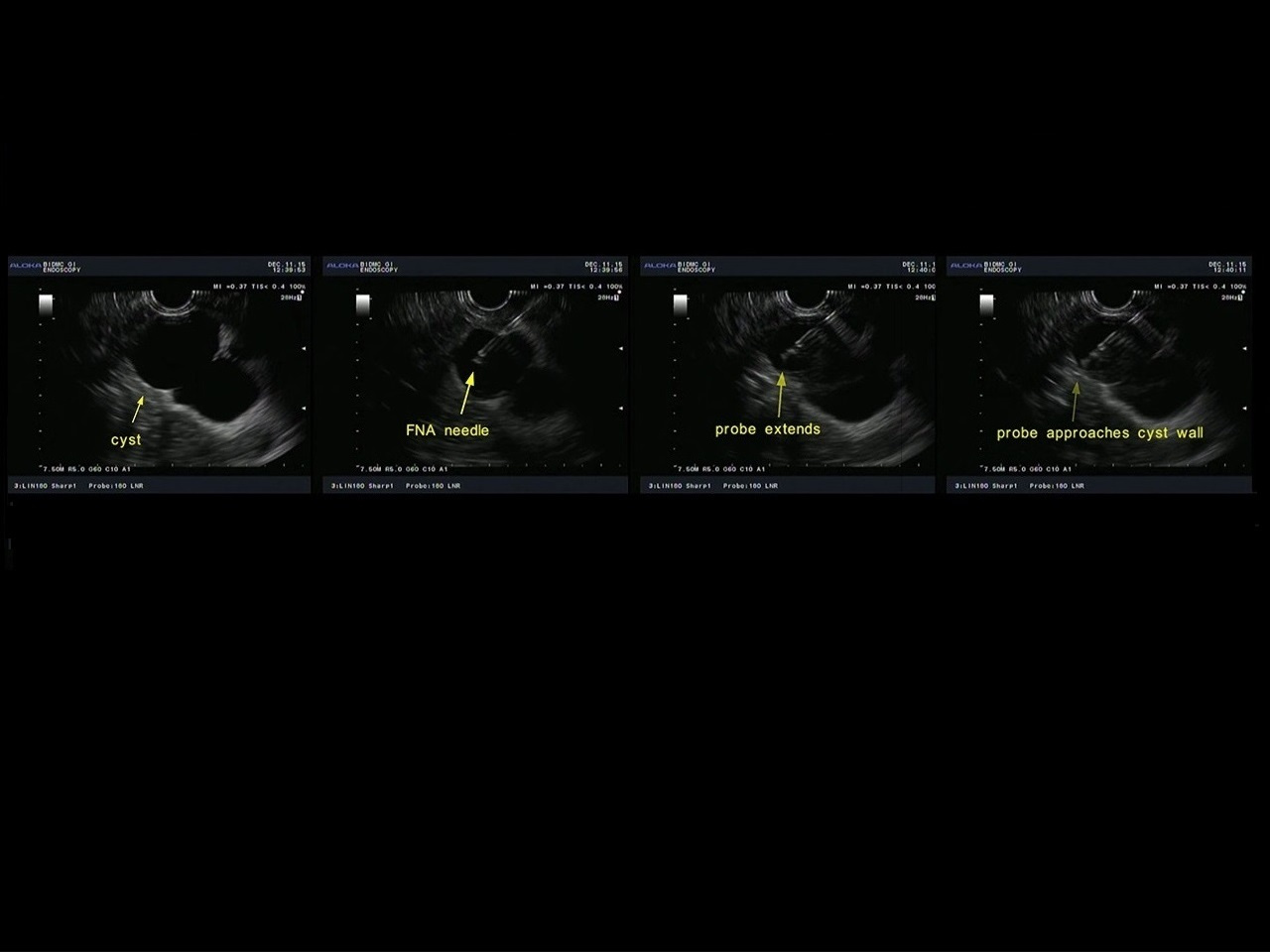 Light scattering spectroscopy identifies cysts with early pancreatic cancer
